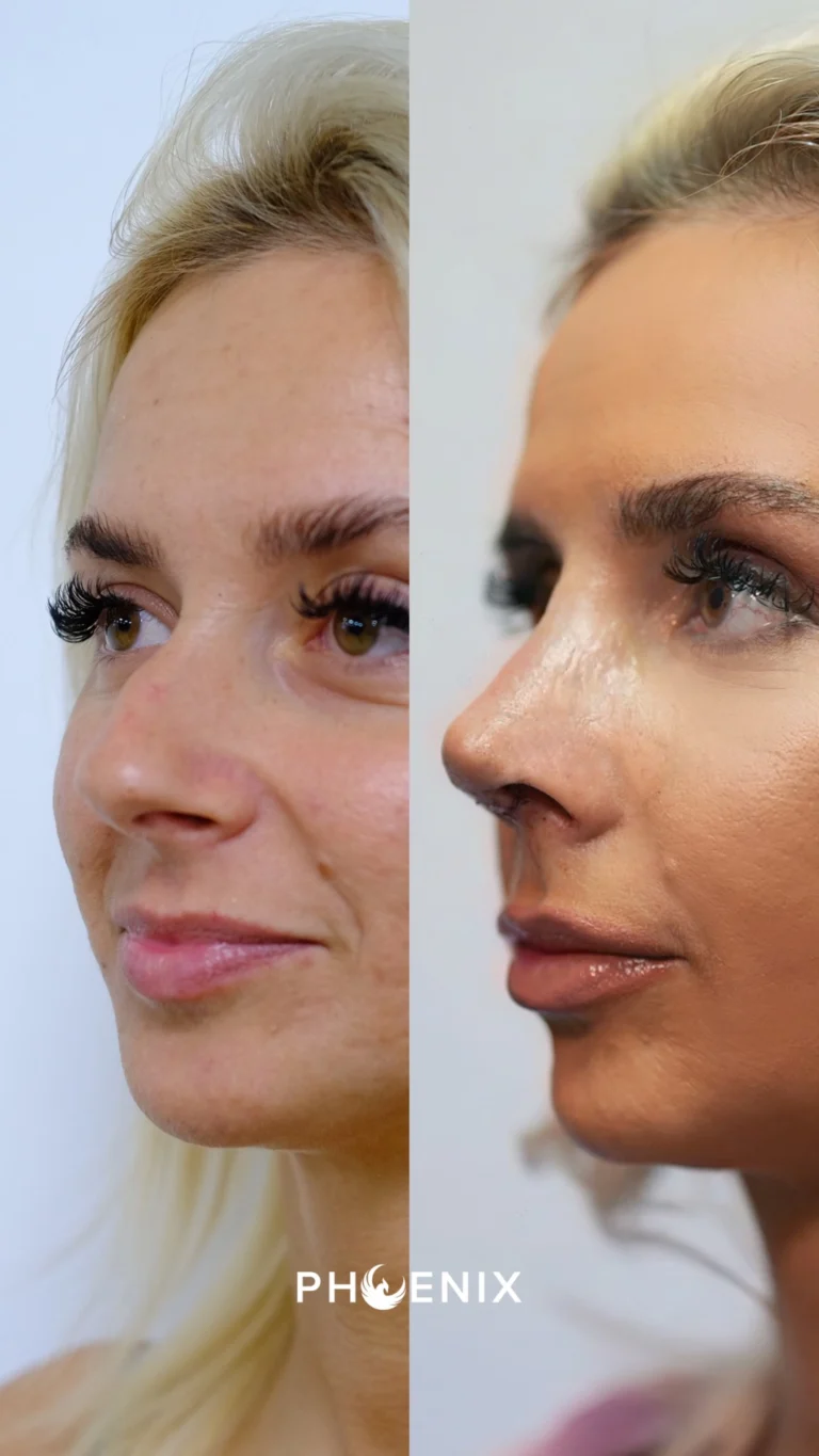nose rinoplasty phoenix aesthetic fatima3