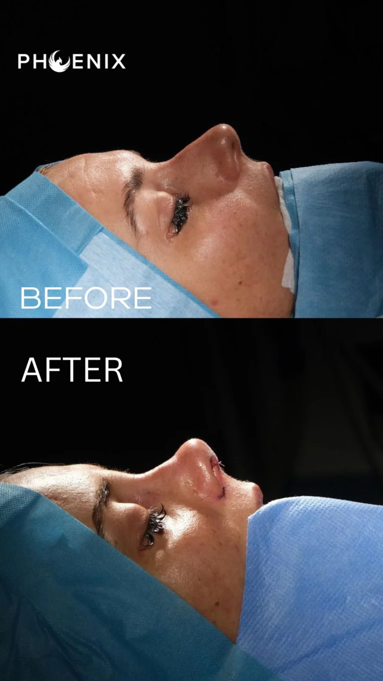 Rhinoplasty surgery