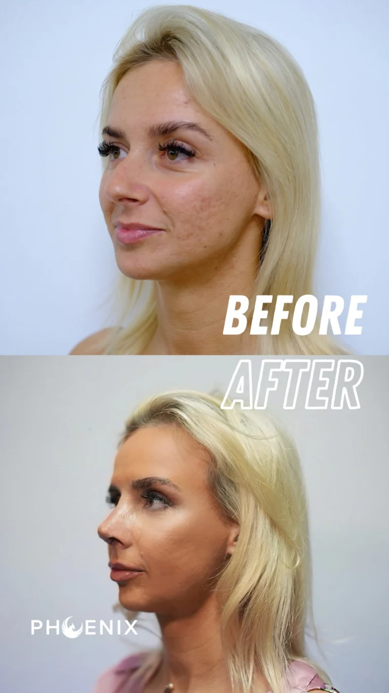 Phoenix Rhinoplasty