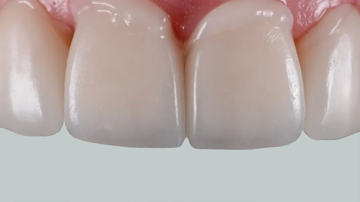 Bonding Tedavisi İstanbul