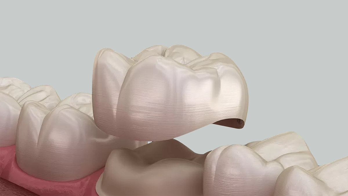 Dental Crowns Aesthetic Turkey