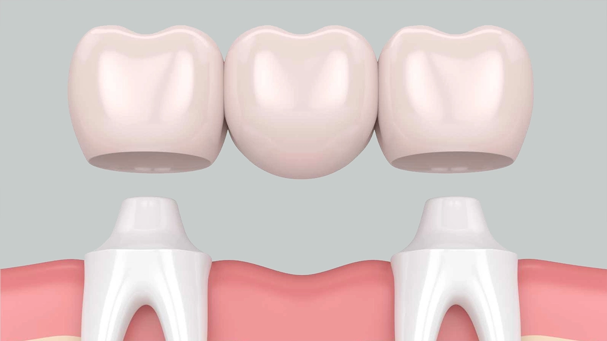 Diş Köprüsü Tedavisi