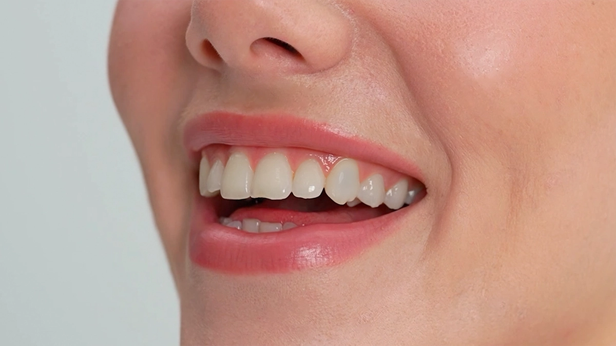 Diş Şekillendirme Tedavisi Öncesi ve Sonrası Nasıldır?