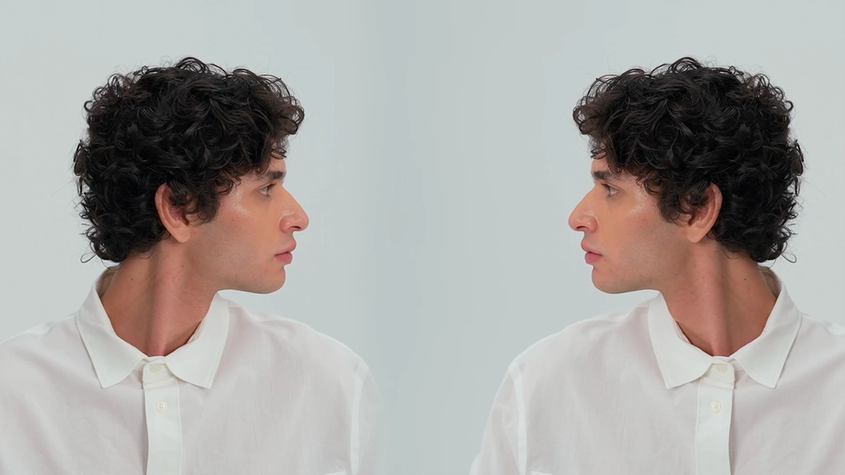 frequently asked questions about hair transplant