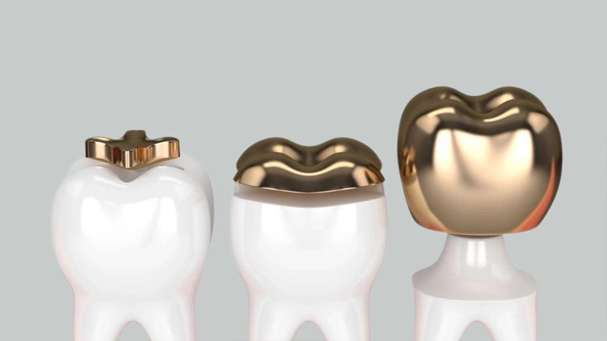 İç Dış Diş Dolgusu Fiyatları