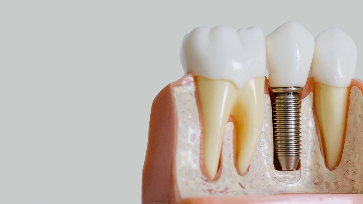 What is the General Process of Implant Treatment?