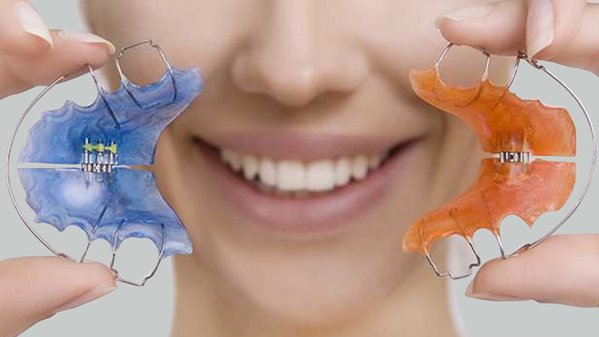 Who Needs teeth Retainers?