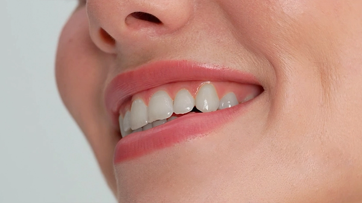 Teeth Whitening Treatment in Turkey