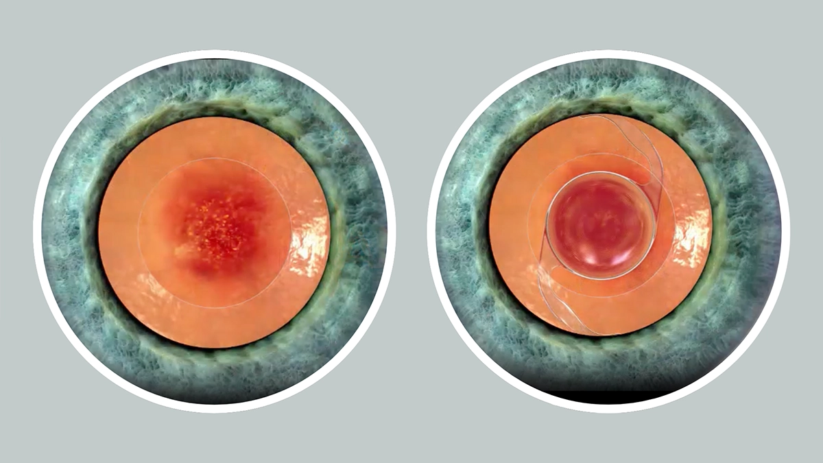 How is Senile Macular Degeneration Treated