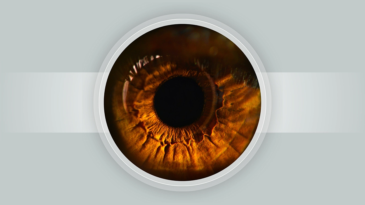 Senile Macular Degeneration​