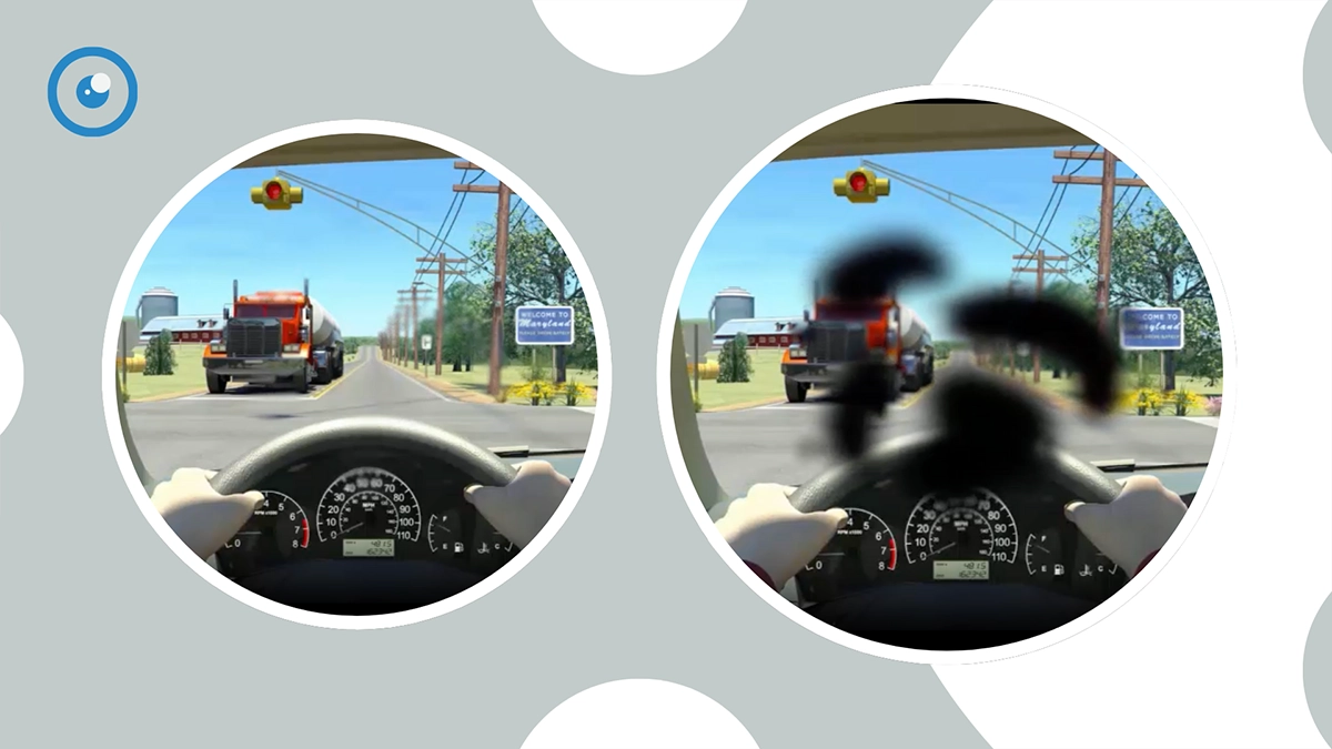 What is Senile Macular Degeneration