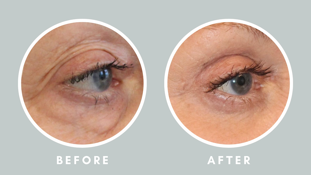 blepharoplasty before after
