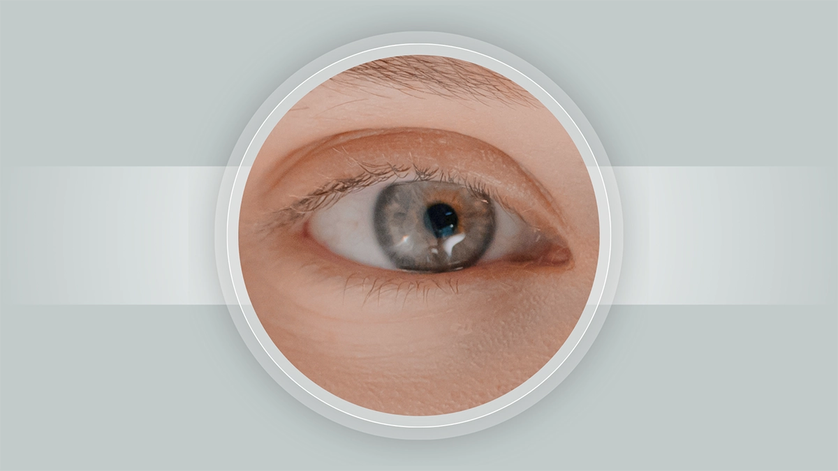 Cataract treatment Turkey