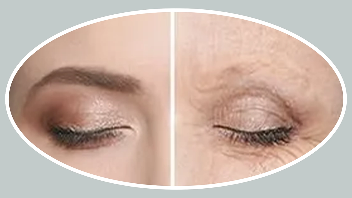 fibroblast therapy before after