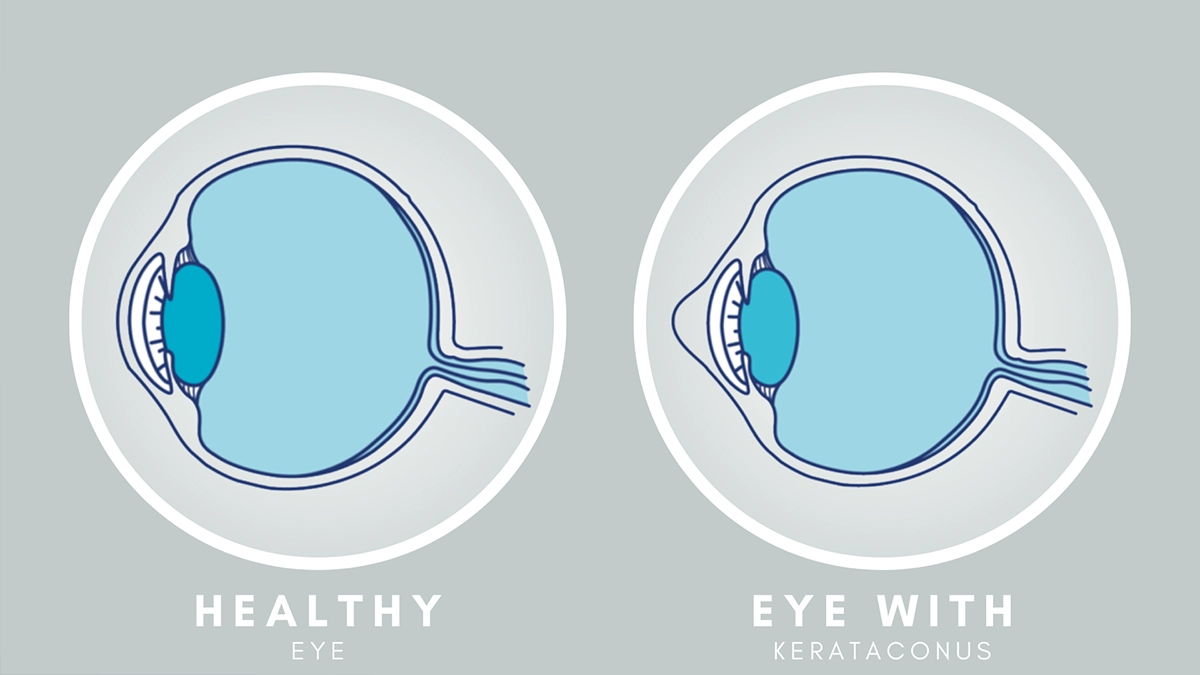 how is keratoconus treated