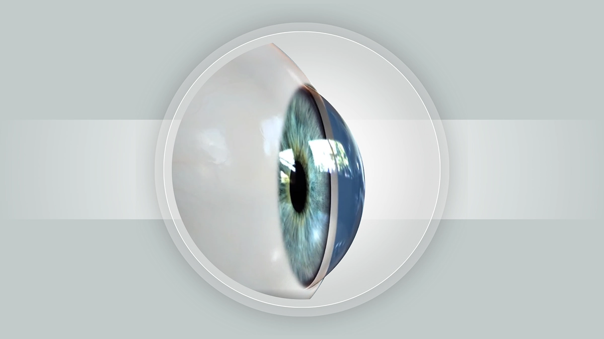 keratoconus treatment