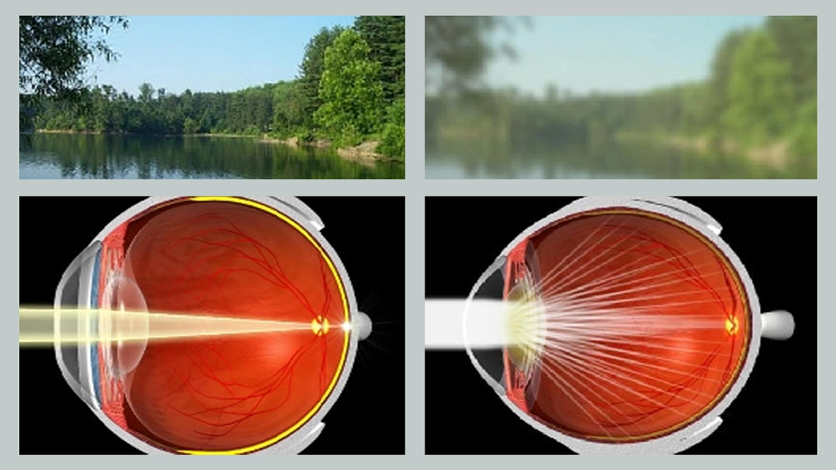 what causes cataracts