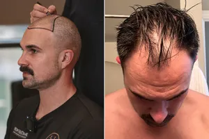Life Changing Hair Transplant 030725 tout 30be3e3716f447e3b4411fc2029fe03b