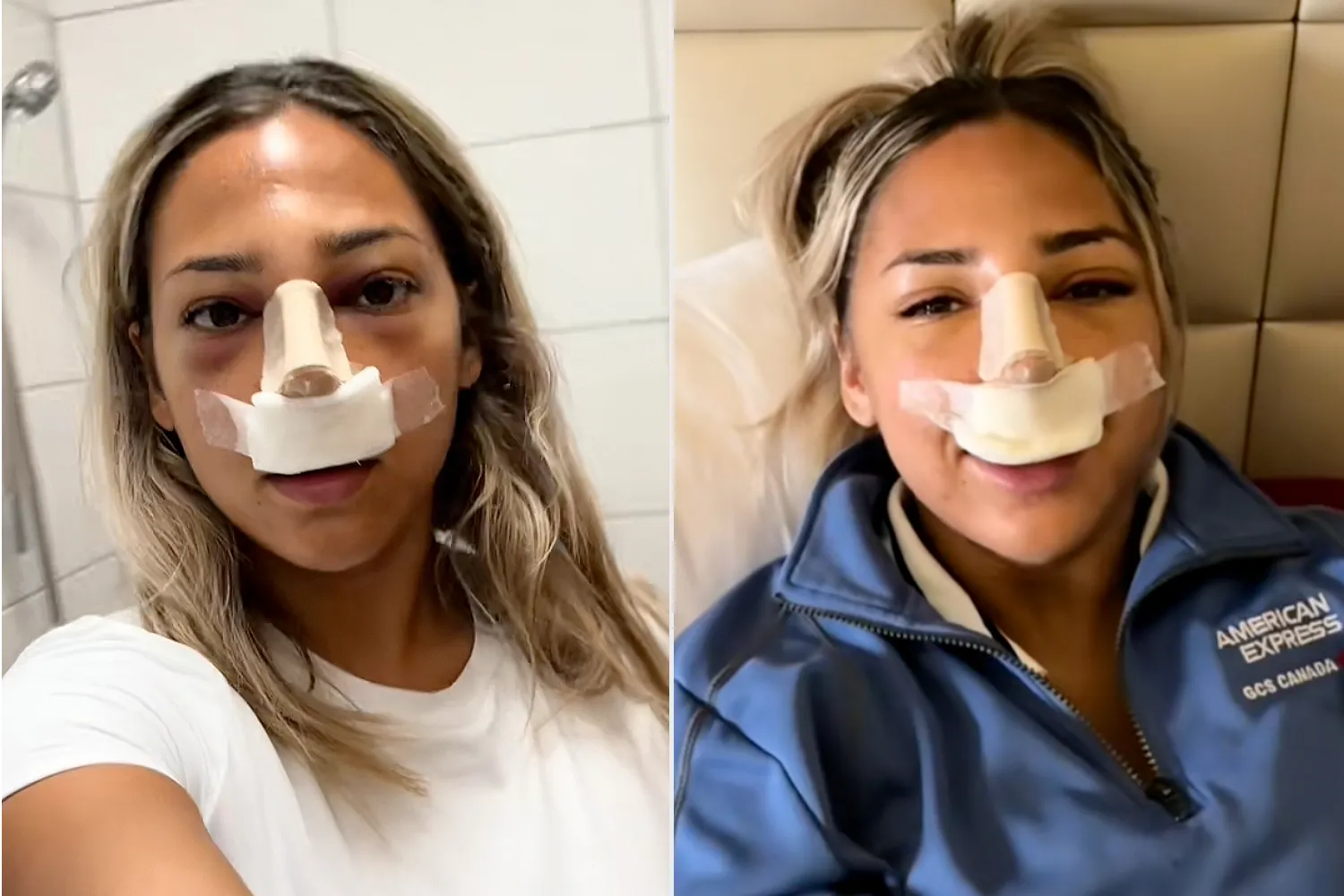 Nose Job Turkey 072125 2 8a3e58a5fd004785a3d043faf6c83bb6