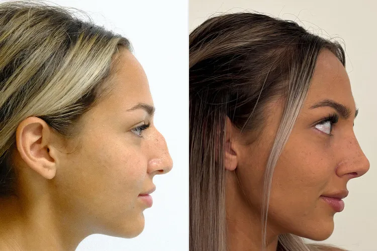 Nose Job Turkey