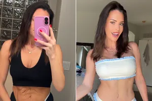 Woman cosmetic surgery in Turkey 071425 1 720c5df585564fdb90e13676d020b5da